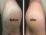 Guide about how to get rid of calluses on feet