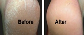 Guide about how to get rid of calluses on feet
