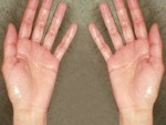 how to get rid of clammy hands
