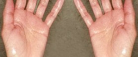 how to get rid of clammy hands