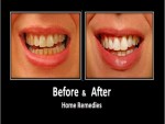 Bleach Your Teeth