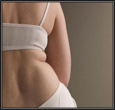 How to Get Rid of Back Fat How to Get Rid of Back Fat