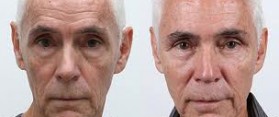 How to Get Face Fat