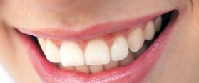 Naturally White Teeth