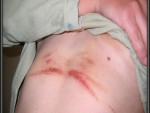how to Relieve Painful Chafing