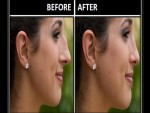 Get Smaller Nose without Surgery