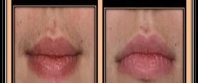 Wax an Upper Lip