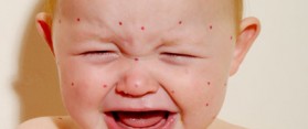 Bathing a child with chickenpox