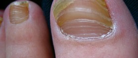 Toenail Fungus