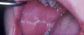 Tips about How to Stop Biting your Cheeks from Inside