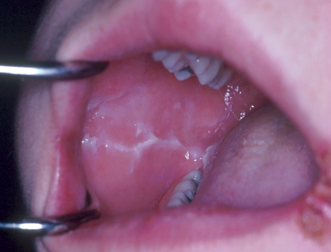 Inside Mouth Swollen 10