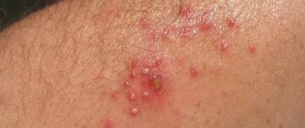 skin infections