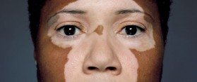 Vitiligo Patient