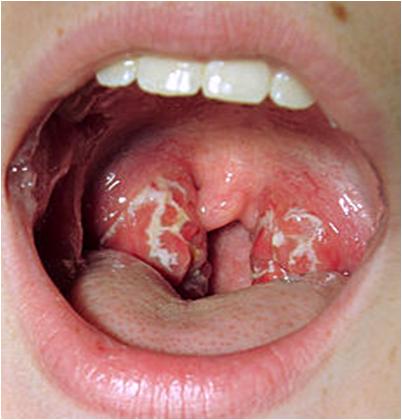 Oral steroid for sinus infection