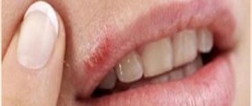 How to Heal Cold Sore on Lips