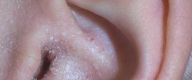 Blackheads in ear