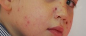 Remove Chickenpox Scars From Face