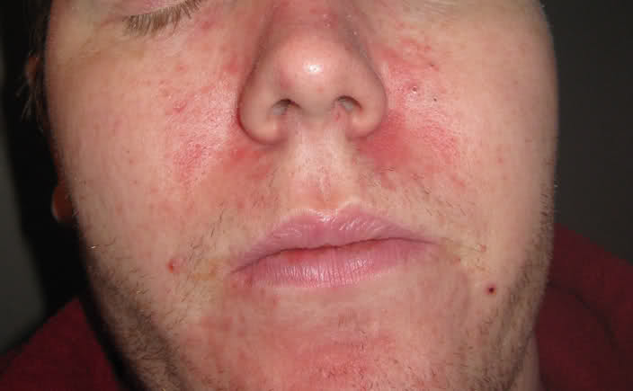 redness dry skin on face