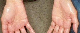 Sweaty Hands and Feet