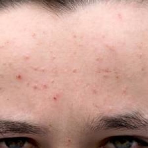 how to treat cystic acne