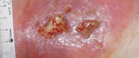 Treat a Septic Wound