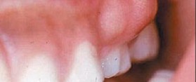 Tooth Abscess