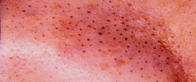 Tips to Get Rid Of Blackheads with Omega 3