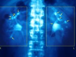 Pass Kidney Stones Pain Free