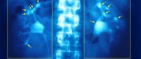 Pass Kidney Stones Pain Free