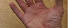 Remove a Wood Splinter from Skin