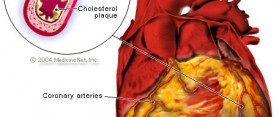 Coronary Artery Disease