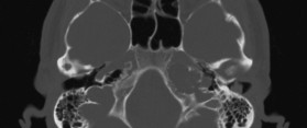 Apical Petrositis