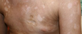 Graft Versus Host Disease