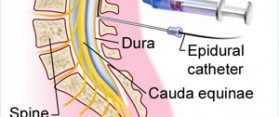 Epidural and Spinal