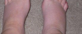 Edema