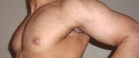 Get Rid of Stretch Marks