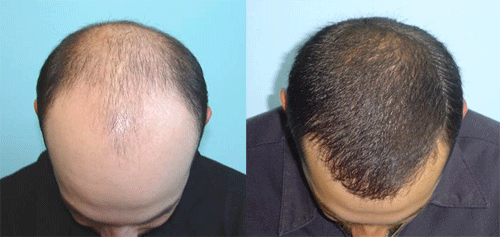 Hair Transplant Surgery in London