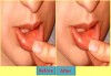 Canker Sore
