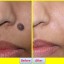 Get Rid Of a Mole without Surgery