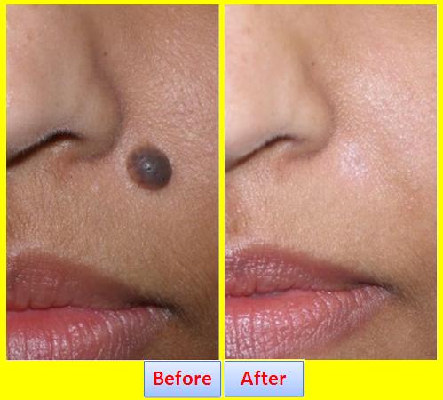 Get Rid Of a Mole without Surgery