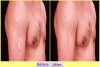 Get Rid Of a Ringworm At Home