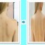 Get Rid of back acne