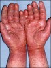 Result of Latex Allergy