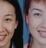 acne scars before and after