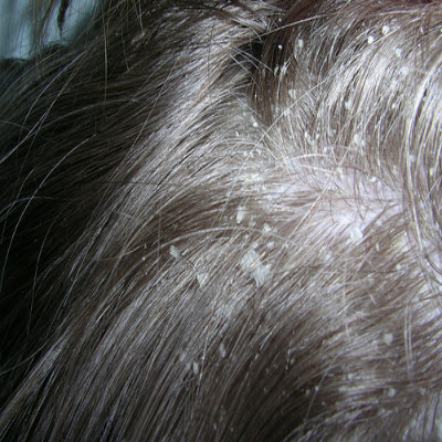 white scalp flakes)