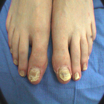 Fungal Nail Infection