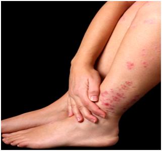how to get rid of eczema