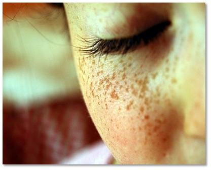 how to get rid of freckles naturally