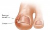 Cushion Toe Nail