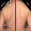 Gettong Rid of Back Hairs